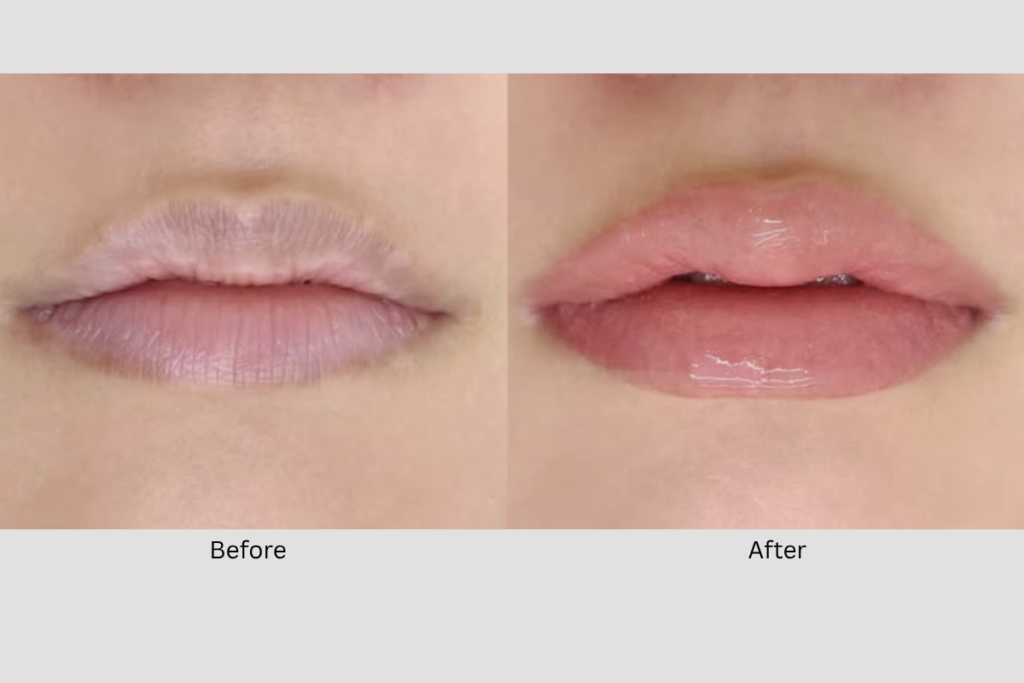 Lip darkening correction, lip line enhancement, and asymmetry correction treatment results on lips showing balanced shape, defined borders, and natural pink tone Orchard Singapore