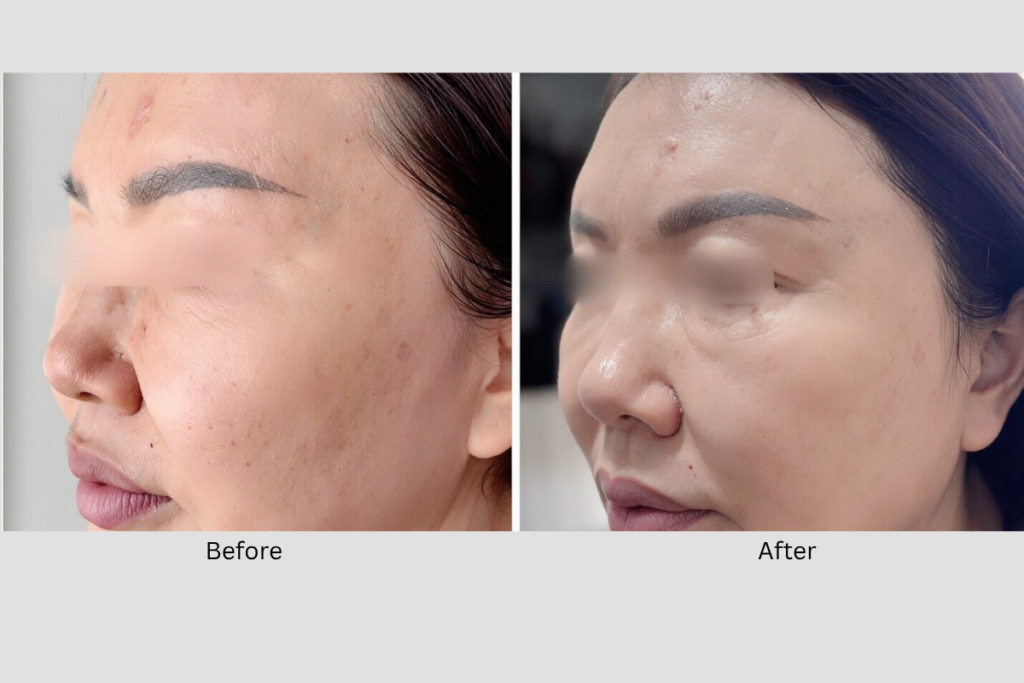 Micro-needling skin reset facial treatment on client's face at Orchard Spa Singapore